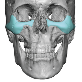 buccal lipectomy Archives - Explore Plastic Surgery