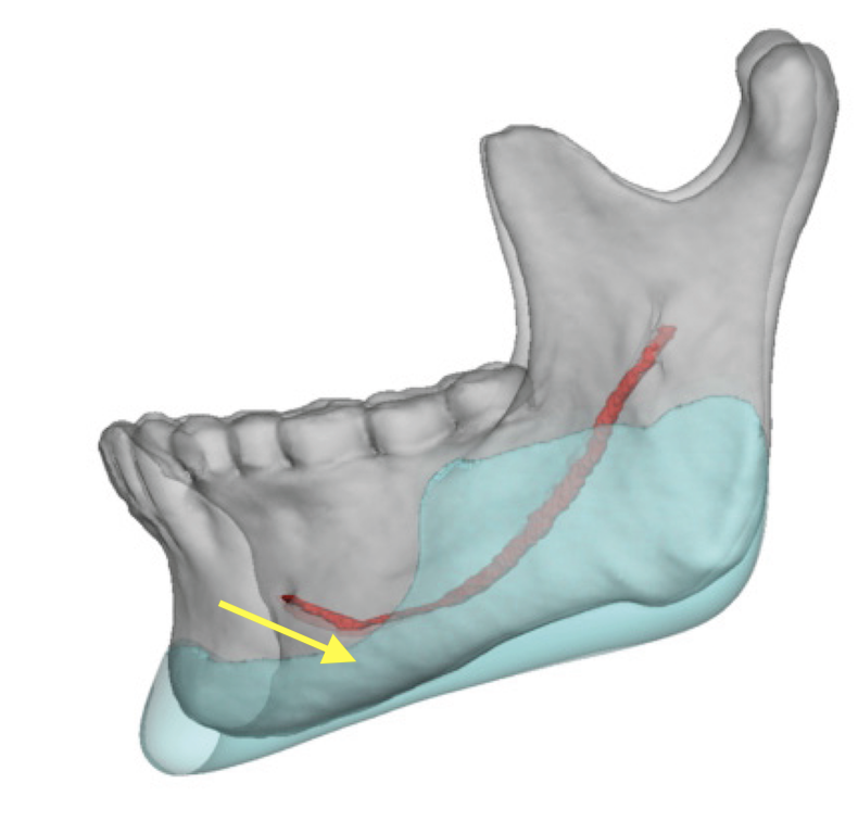 retroclined inferior alvelar nerve exist Dr Barry Eppley Indianapolis ...