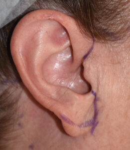 How to Reduce Large Ears and Earlobes - Visage Cosmetic Plastic Surgery