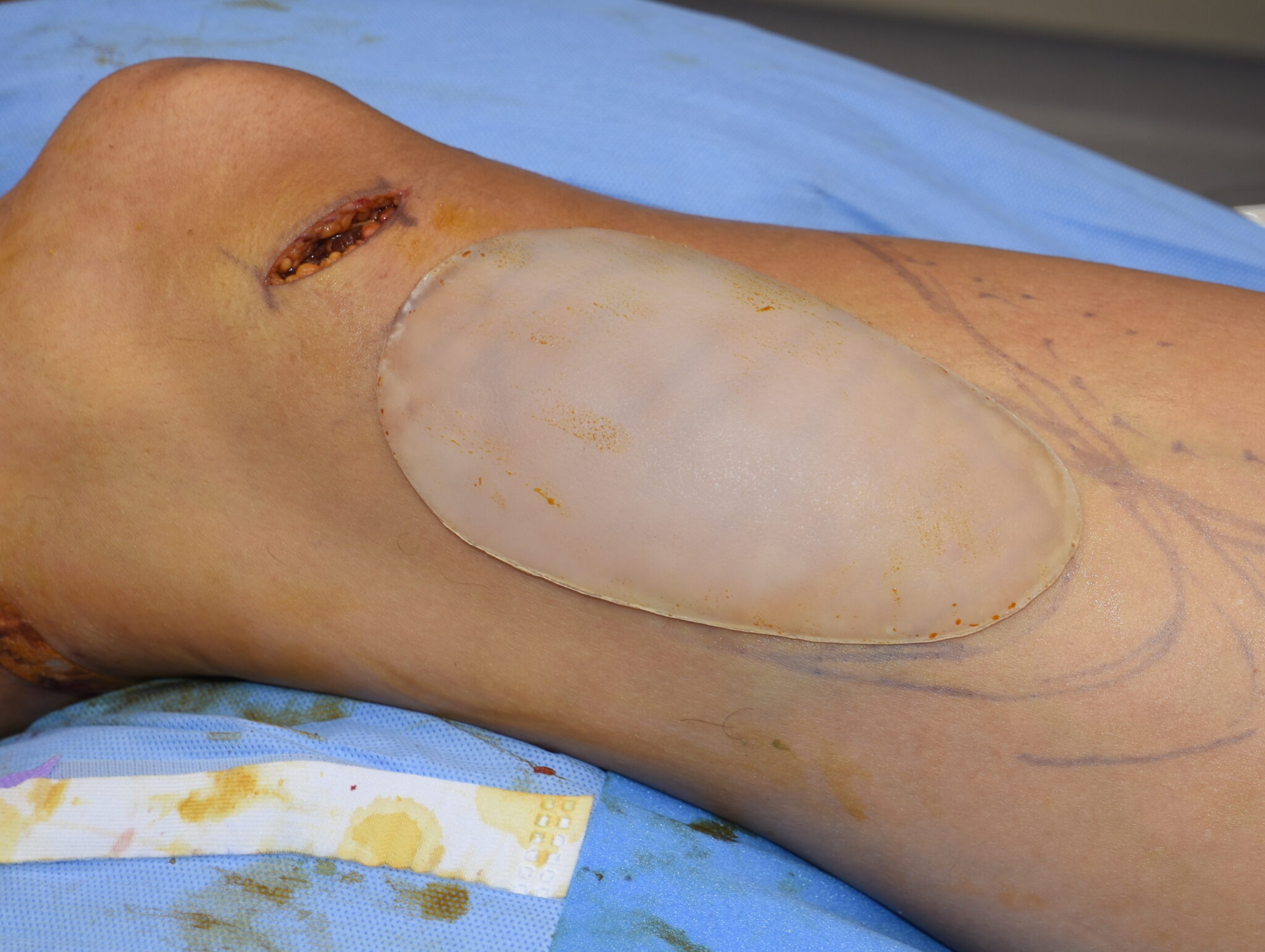 Aesthetic Implant Augmentation Of The Vastus Medialis Muscle of the