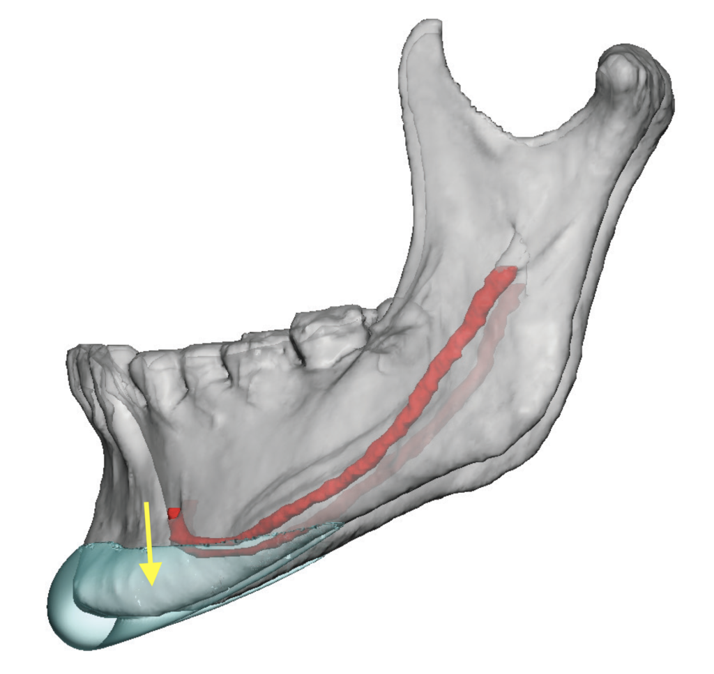 Inferior Alveolar Nerve Block Inferior Alveolar Nerve - Vrogue.co