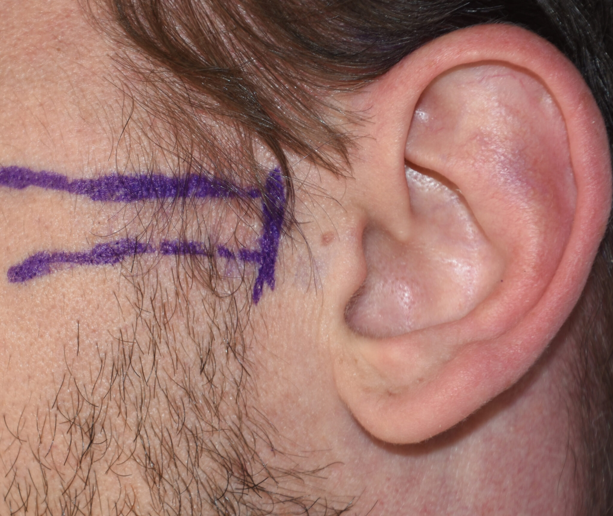 Technical Strategies - The Posterior Zygomatic Arch Osteotomy in