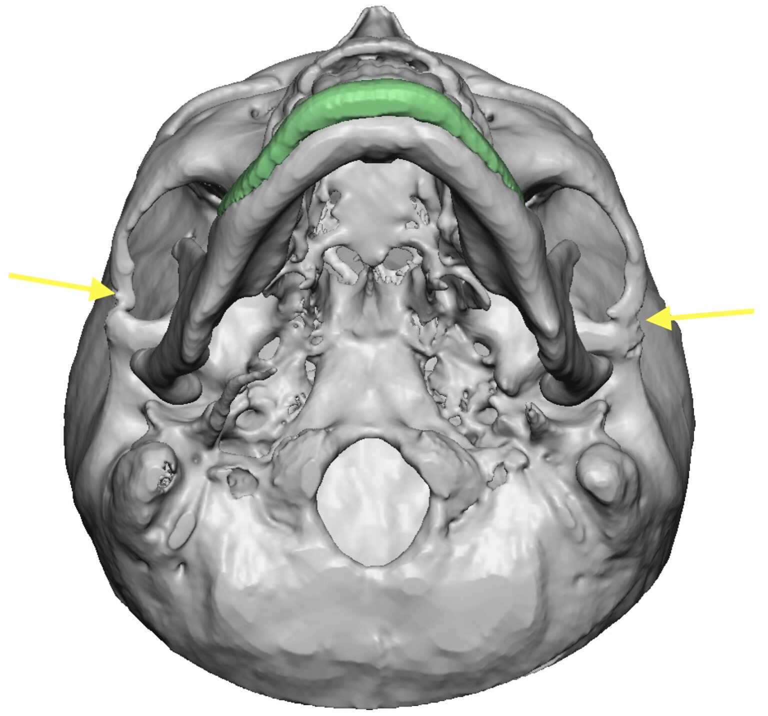 Posterior zygomatic arch osteotomy 3D CT scan Dr Barry Eppley ...