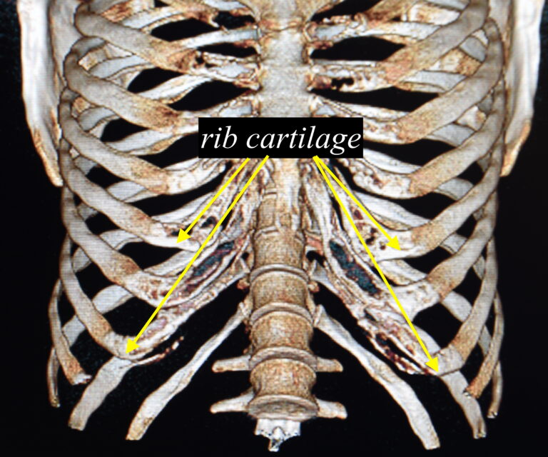 Rib cartilage of subcostal region 3D CT scan Dr Barry Eppley