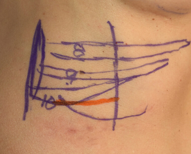 Right Subcostal Rib Removal incision Dr Barry Eppley Indianapolis