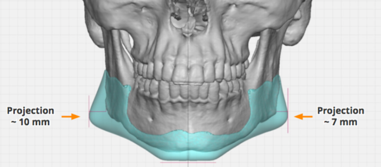 Plastic Surgery Case Study - Design and Placement Considerations of the ...