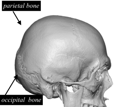 Flat Back Of Head Skull Anatomy Dr Barry Eppley Indianapolis Explore Plastic Surgery