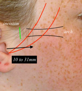 The Pathway of Facial Nerve Branches in Cheekbone Reduction Surgery