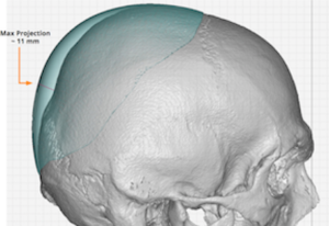 Concepts in Custom Skull Implants For Flat Back Of The Head ...