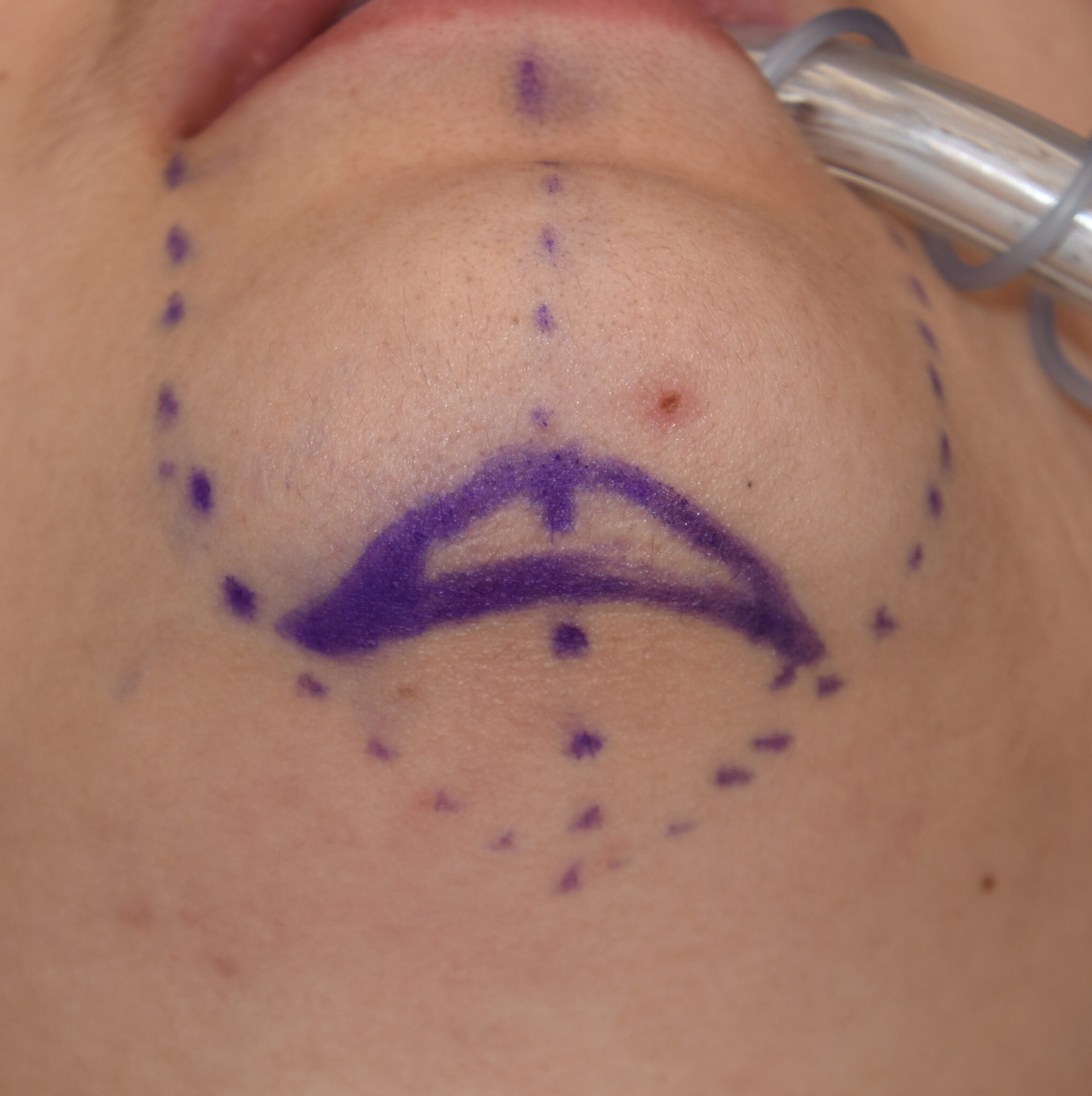 Unilateral ptosis treatment picture
