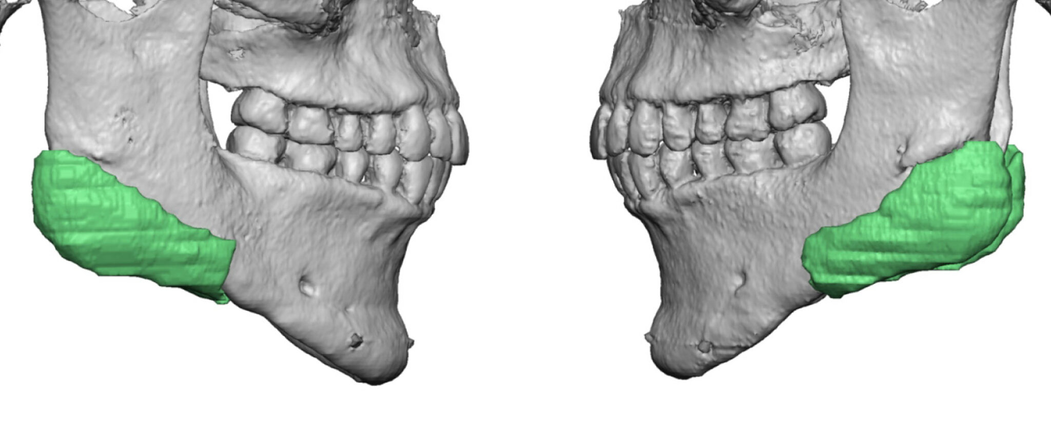 Comparison of Standard Medpor vs Custom PEEK Jaw Angle Implants