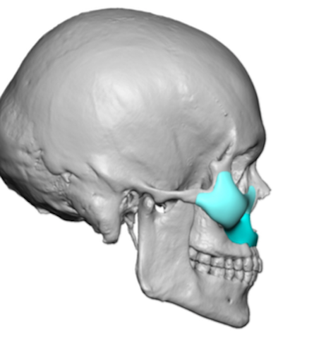 Plastic Surgery Case Study - The Custom Midface Mask Implant for ...