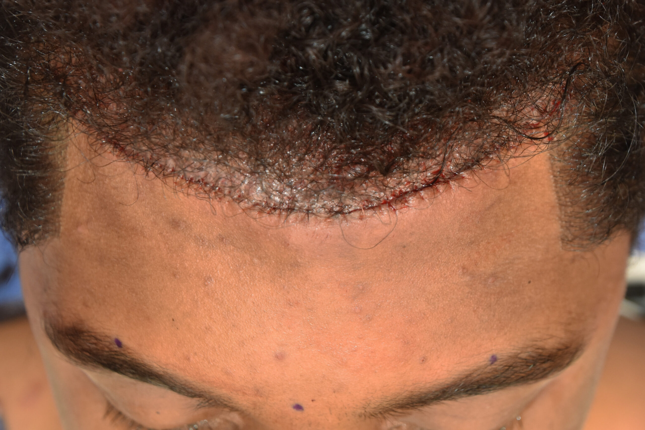 Plastic Surgery Case Study - Frontal Hairline Advancement for Combined Hair  Transplant Removal and Forehead Reduction - Explore Plastic Surgery