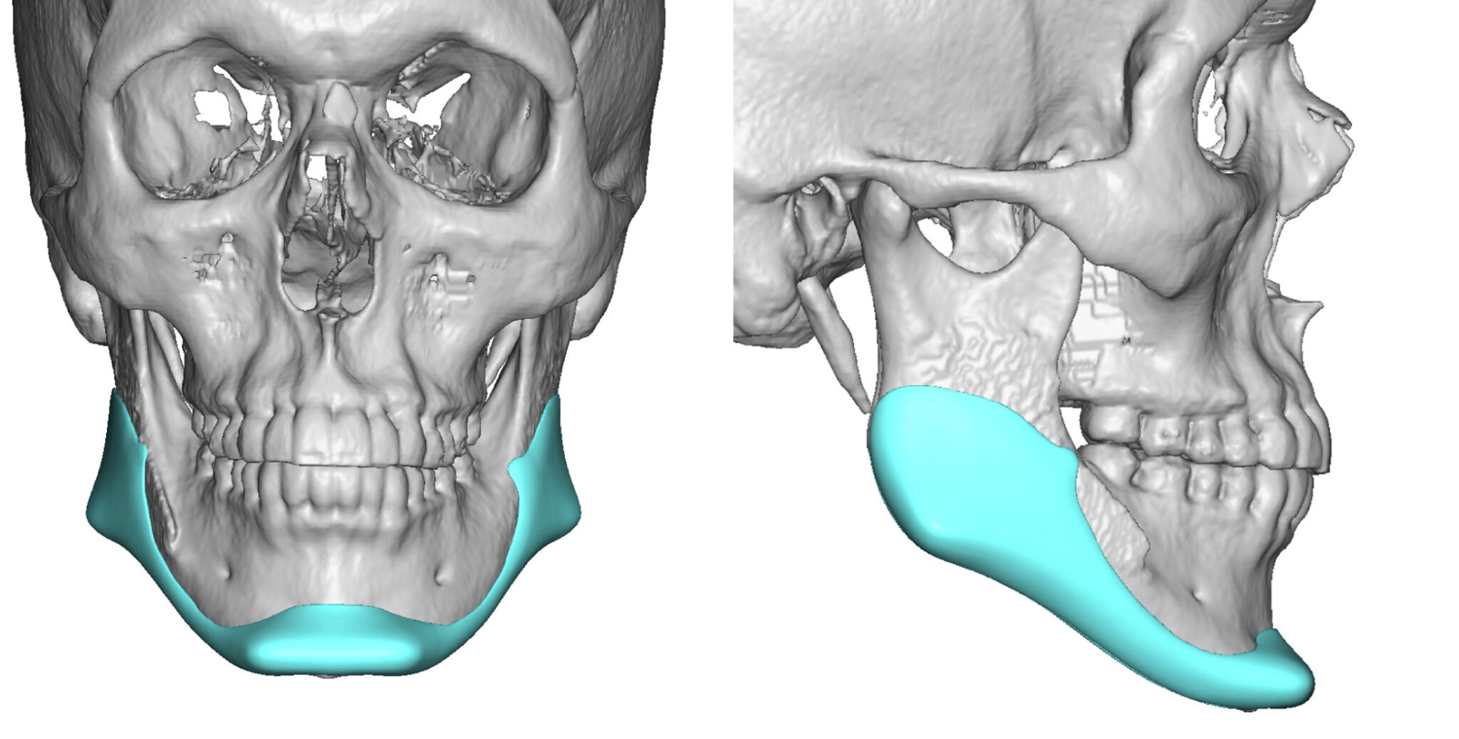 The Significance of the Antegonial Notch in Custom Jawline Implant ...