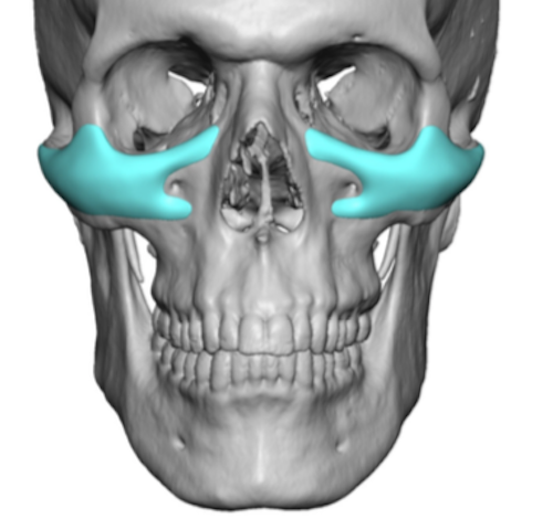 Custom infraorbital malar implant design front view Dr Barry Eppley ...