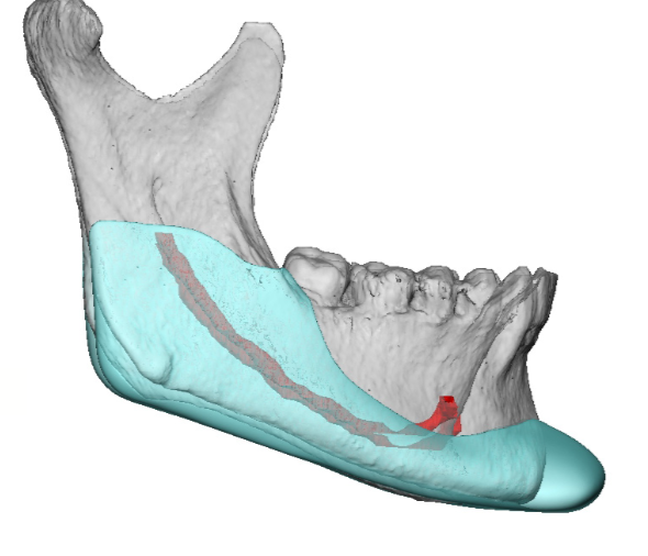 The Significance of the Antegonial Notch in Custom Jawline Implant ...