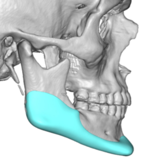 The Significance of the Antegonial Notch in Custom Jawline Implant ...