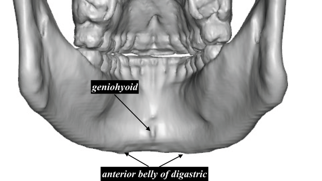 The Differing Effects of A Sliding Genioplasty vs Chin Implant On The
