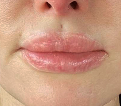 Plastic Surgery Case Study - Upper and Lower Lip Advancements for ...