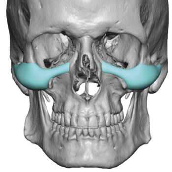 cheek implants Archives - Explore Plastic Surgery