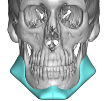 Plastic Surgery Case Study = Chin Implant Replacement with Large Custom ...