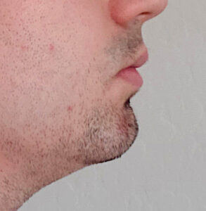 male custom square chin implant side before Dr Barry Eppley ...