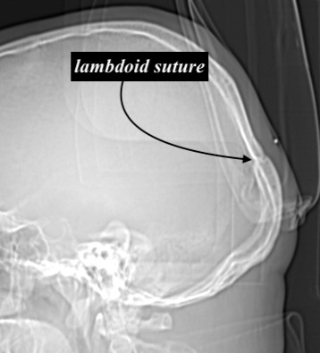 lambdoid suture x ray