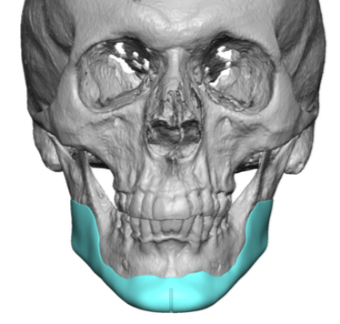 Custom jawline implant design in small male lower jaw front view Dr ...