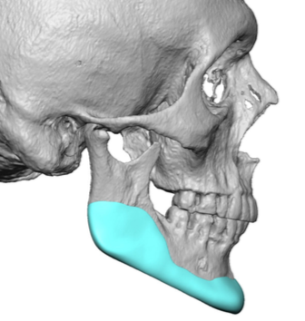 Custom jawline implant design side view Dr Barry Eppley Indianapolis ...