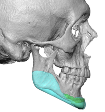 Custom Jawline Implant Design Vs Medpor Chin Implant Side View Dr Barry 