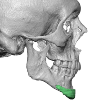 Medpor chin implant in small male lower jaw 3D CT scan side view Dr ...