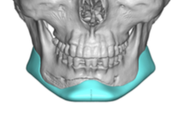 asian custom jawline implant design front view Dr Barry Eppley ...