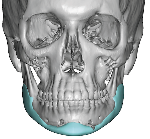 Plastic Surgery Case Study - Female Custom Jawline Implant For Partial ...