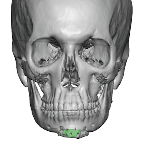 Plastic Surgery Case Study - Female Custom Jawline Implant For Partial 