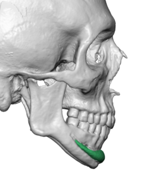 high positioned chin implant 3D CT scan side view Dr Barry Eppley ...