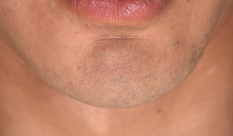 Plastic Surgery Case Study - Male Custom Square Chin Implant ...