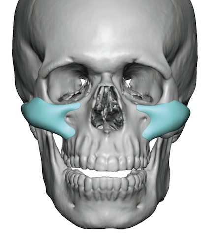 Plastic Surgery Case Study - Intraoperative Modification of Male Custom ...