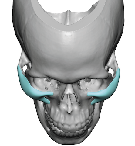 male custom high cheekbone look implants design top view Dr Barry ...