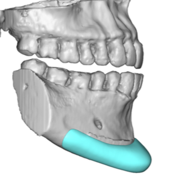 male custom square chin implant design side view Dr Barry Eppley ...