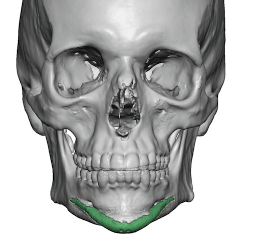 Plastic Surgery Case Study - Chin Implant Imprinting And Bony 