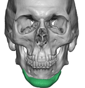 Double stacked chin implant front view 3D CT scan Dr Barry Eppley ...