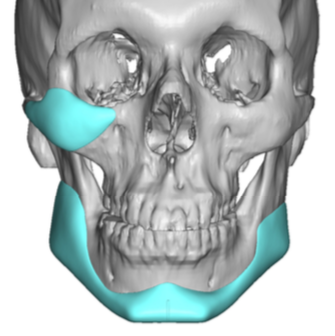 custom facial implant designs for facial asymmetry Dr Barry Eppley ...