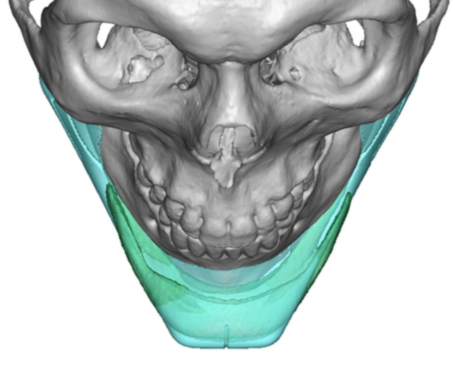 Plastic Surgery Case Study - Double Stacked Chin Implants Replaced By ...