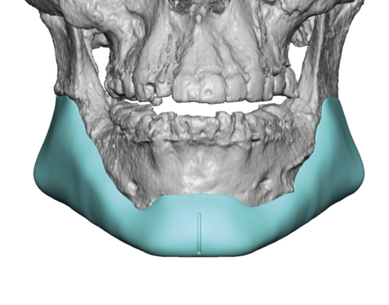 custom jawline implant replacement deisgn for jaw imlpant asymmetries ...