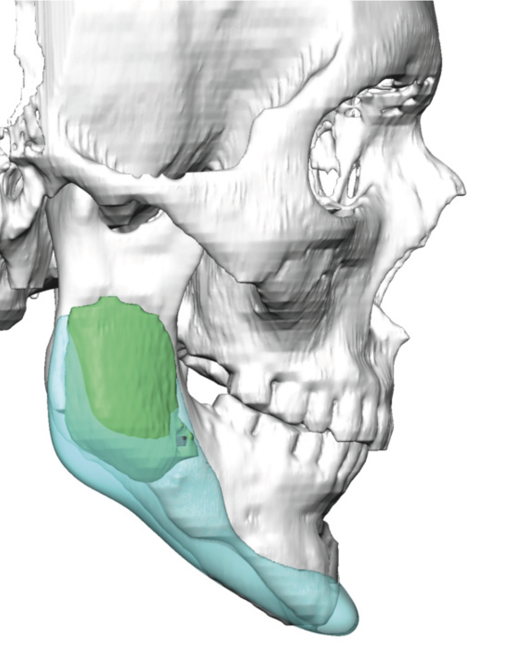 custom jawline implant vs standard facial asymmetry correction right ...