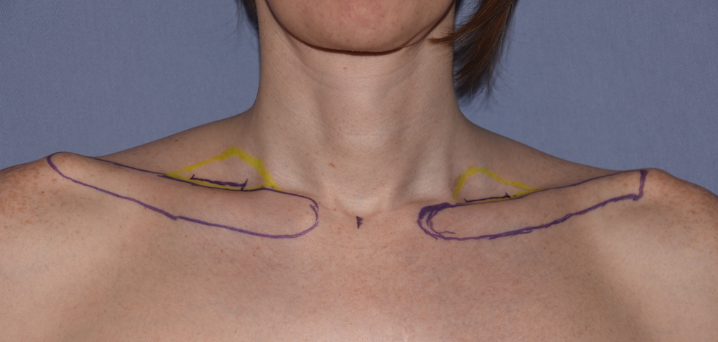 female broad shoulders before Dr Barry Eppley Indiana;polis - Explore  Plastic Surgery