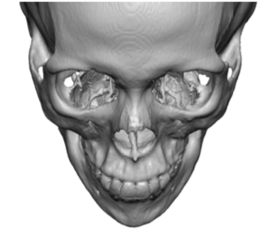 female zygomatic arch shap top view Dr Barry Eppley Indianapolis ...