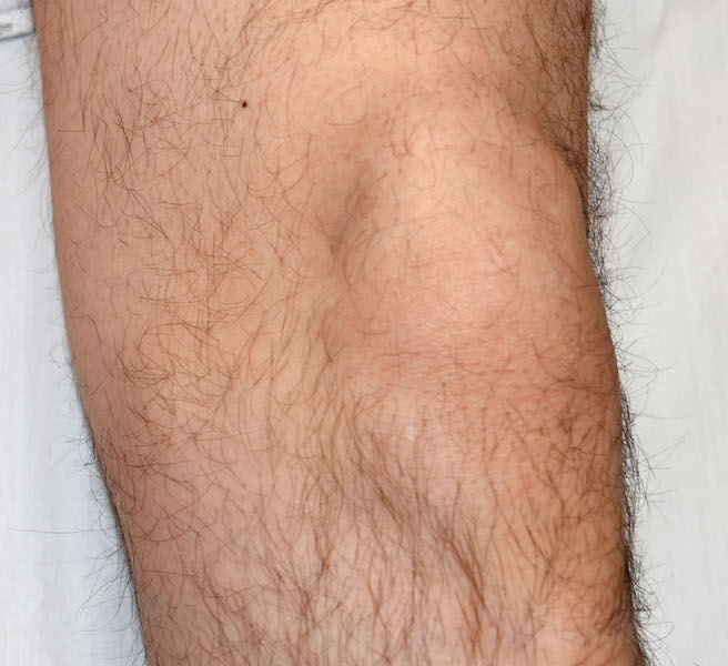 Plastic Surgery Case Study - Aesthetic Removal of Bilateral Knee Cap