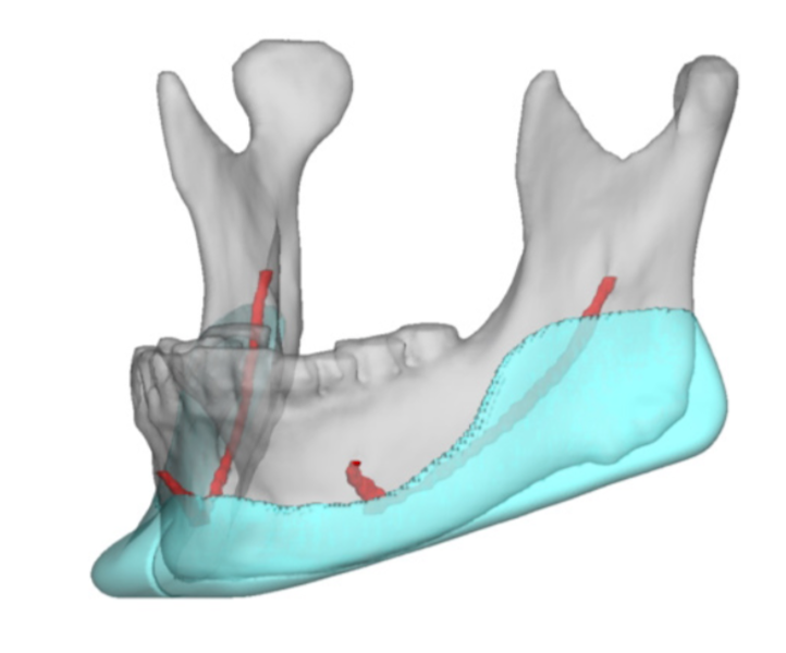 Plastic Surgery Case Study - The Evolution of Chin and Jaw Implant ...