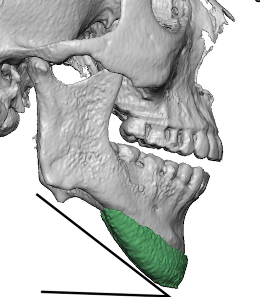 Plastic Surgery Case Study - Malposiitoned Chin Implant Replaced With A ...